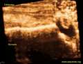 Tenosinovitis_BICEPS_66a_F_3D_imatge_3.jpg